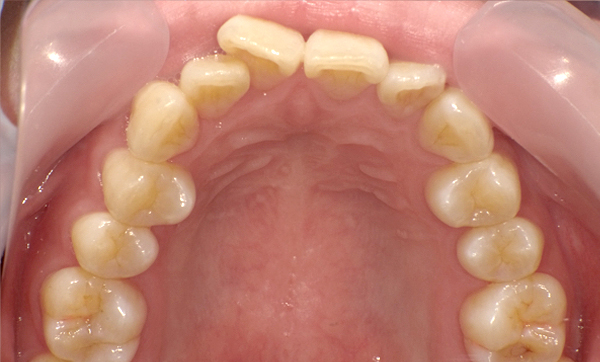 部分矯正 上の部分矯正の症例写真