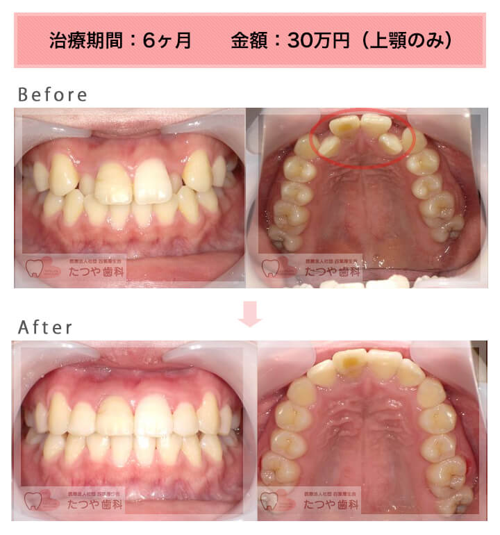 部分矯正の症例 上の前歯だけ