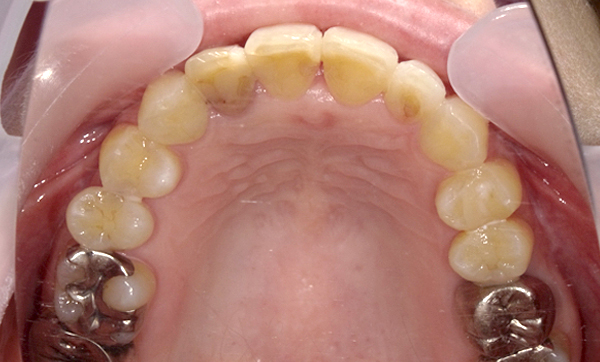 部分矯正 上の部分矯正の症例写真