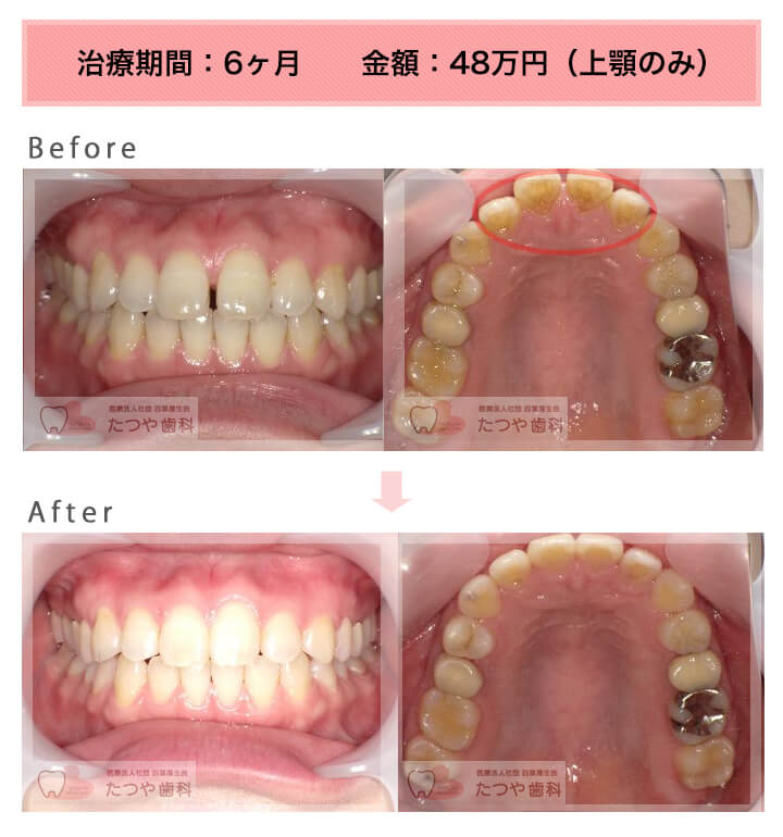 部分矯正の症例　上の前歯だけ