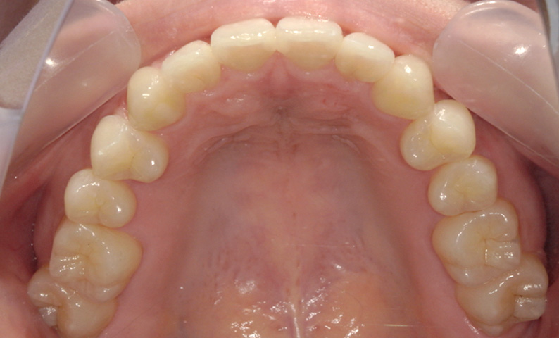 部分矯正 上の部分矯正の症例写真