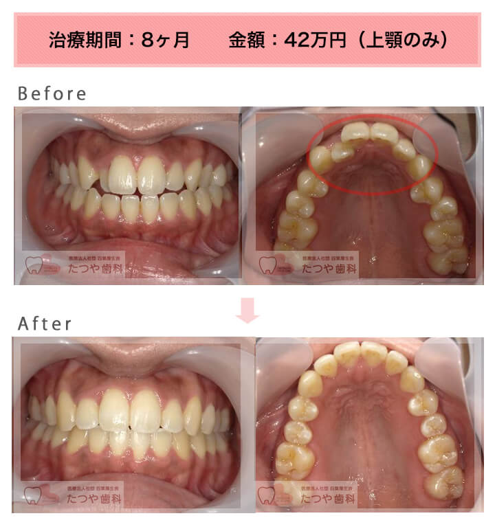 部分矯正の症例 上の前歯だけ