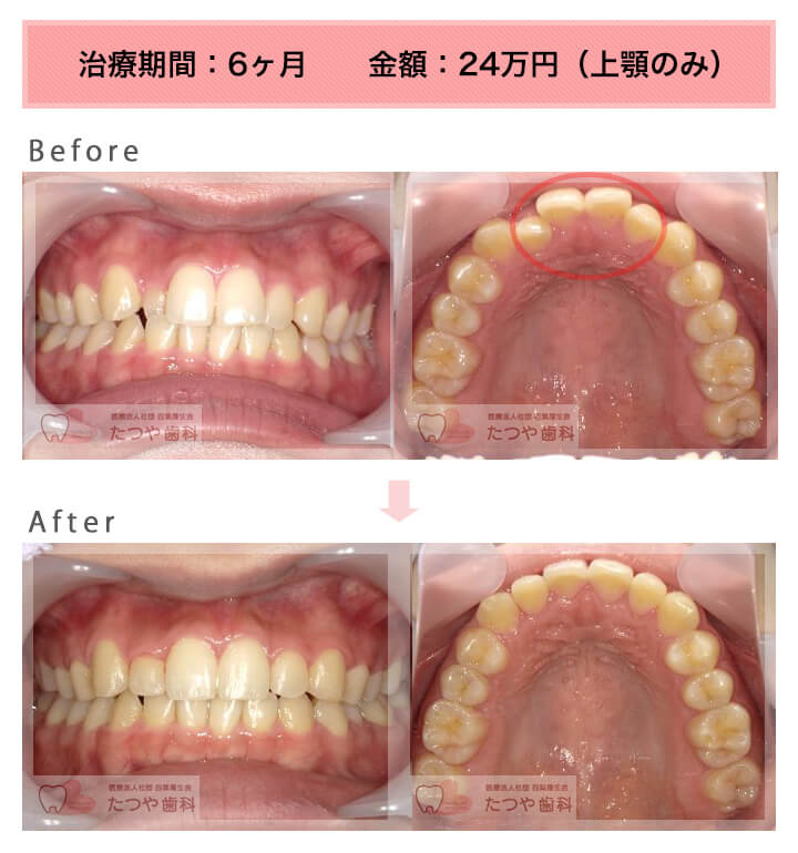 部分矯正の症例 上の前歯だけ