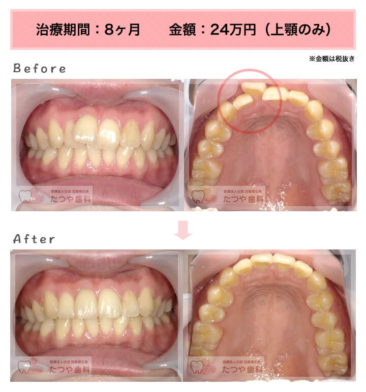 部分矯正の症例 上の前歯だけ