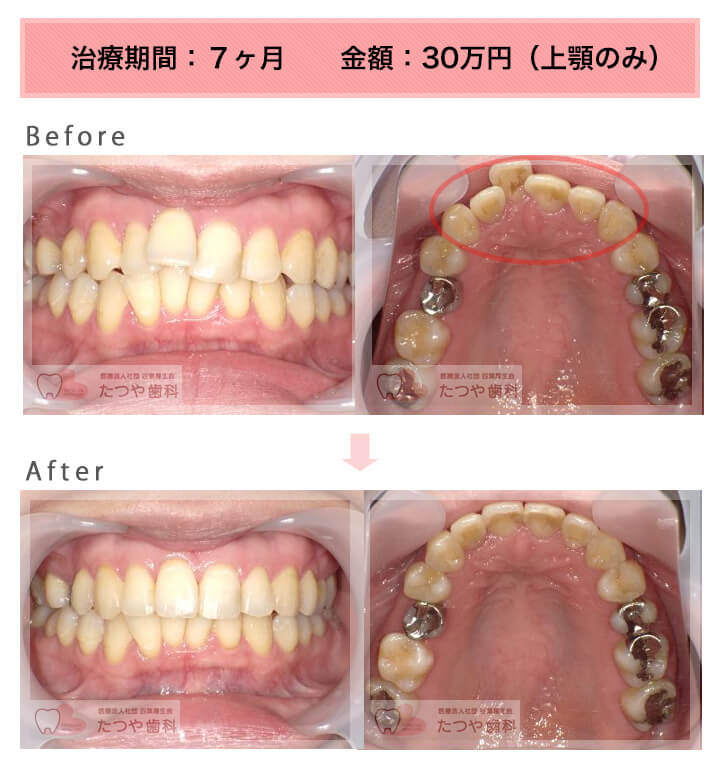 部分矯正の症例 上の前歯だけ