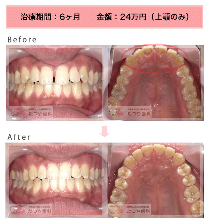 部分矯正の症例 上の前歯だけ