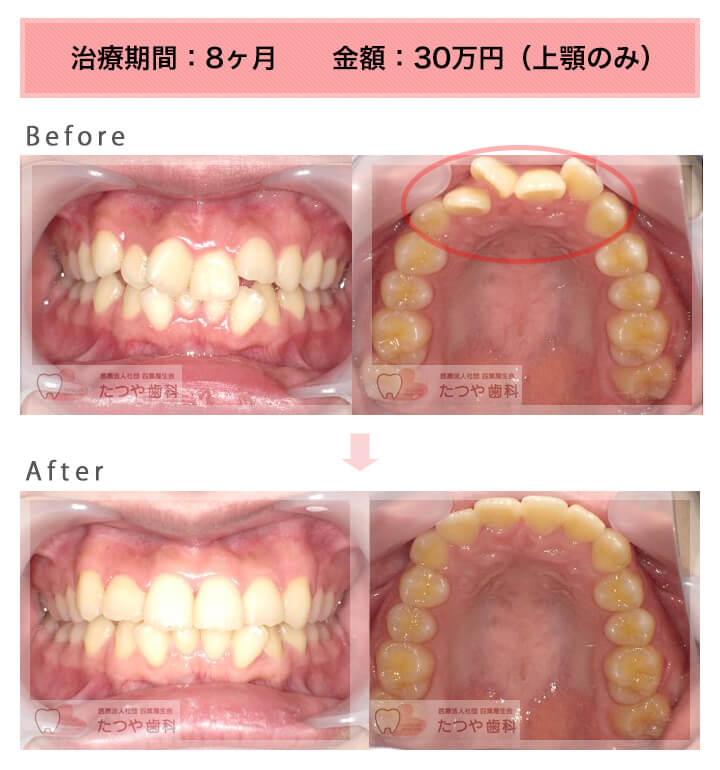 部分矯正の症例 上の前歯だけ
