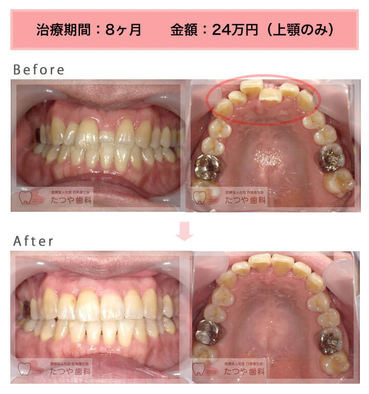 部分矯正の症例 上の前歯だけ