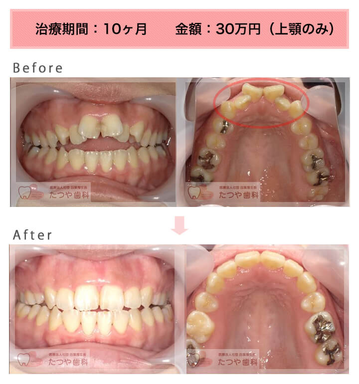 部分矯正の症例 上の前歯だけ