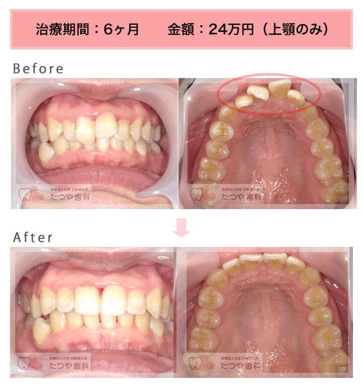 部分矯正の症例 上の前歯だけ