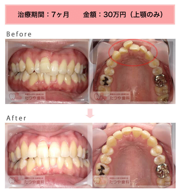 部分矯正の症例 上の前歯だけ