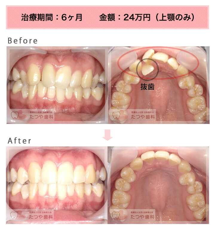 部分矯正の症例　上の前歯だけ