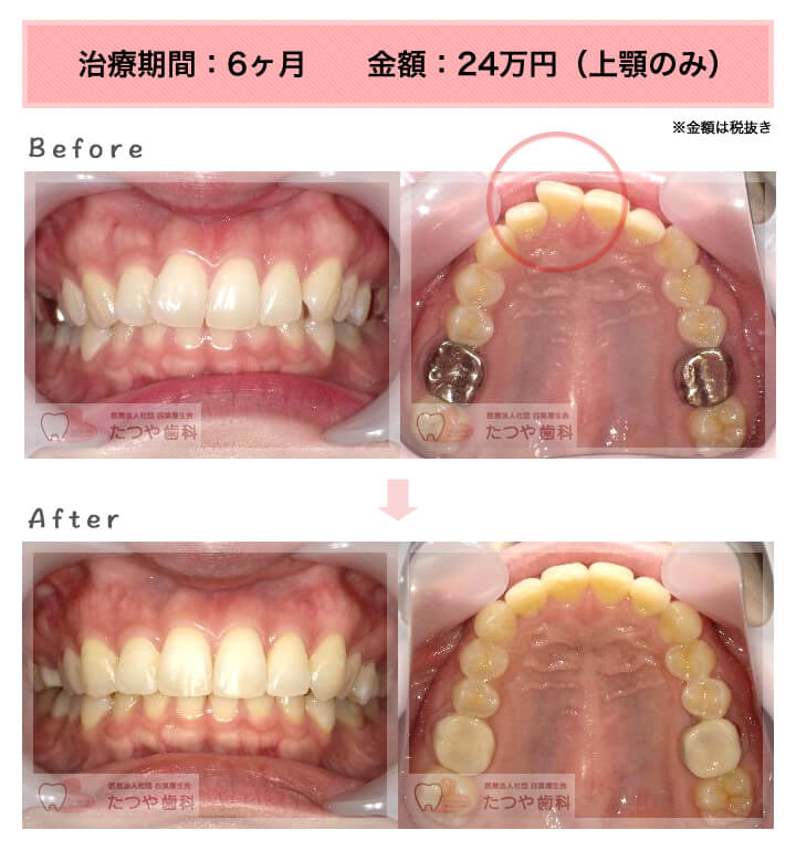 部分矯正の症例　上の前歯だけ