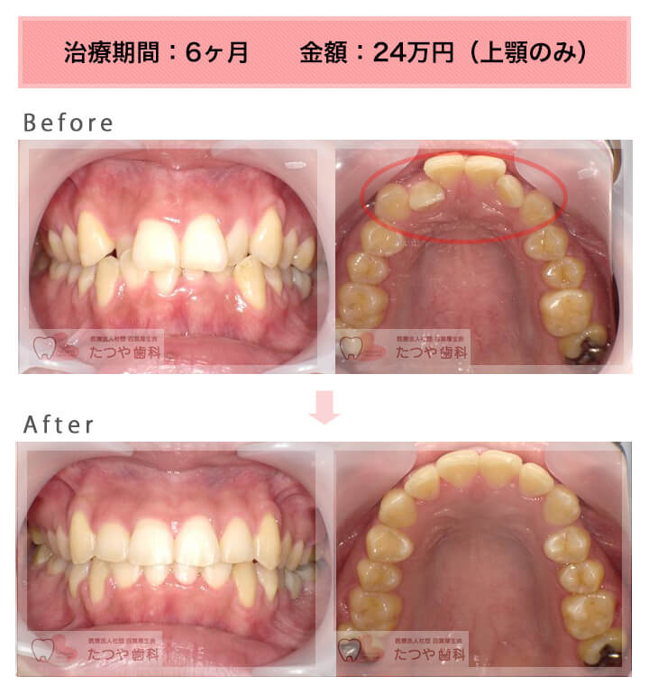 部分矯正の症例 上の前歯だけ