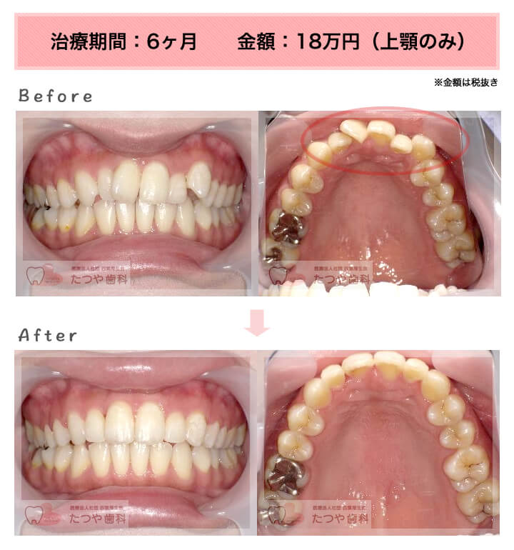 部分矯正の症例　上の前歯だけ