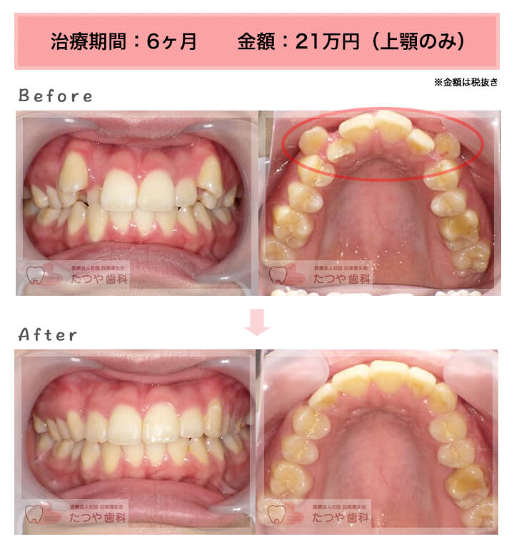 部分矯正の症例　八重歯