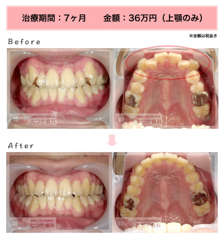 部分矯正の症例　八重歯