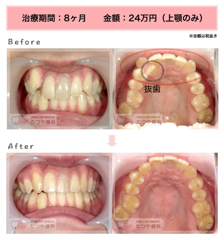 部分矯正の症例　八重歯