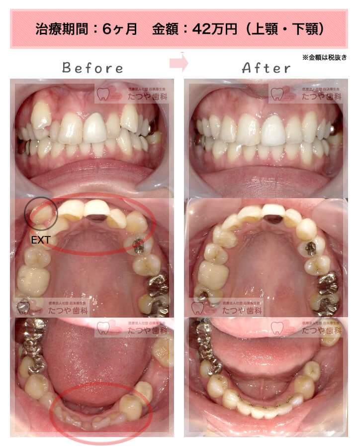 部分矯正の症例　八重歯