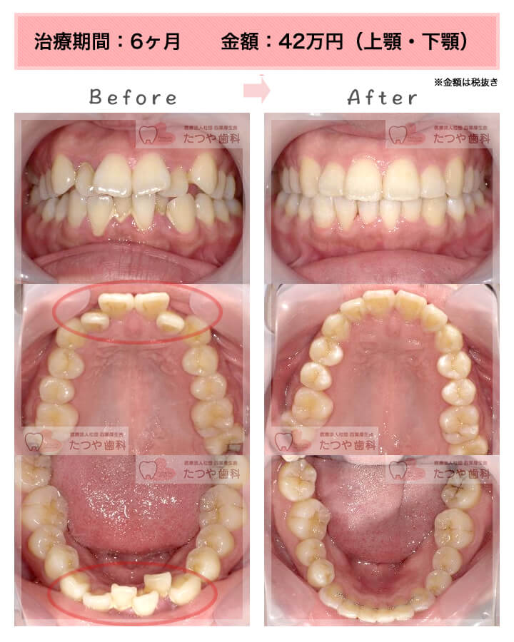 部分矯正の症例　八重歯