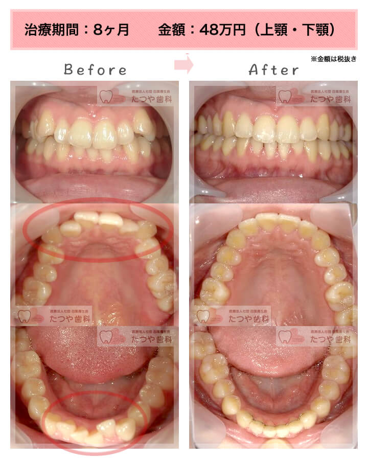 部分矯正の症例　八重歯