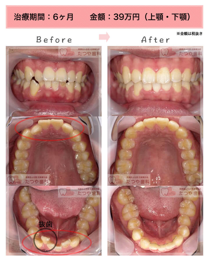 部分矯正の症例　八重歯
