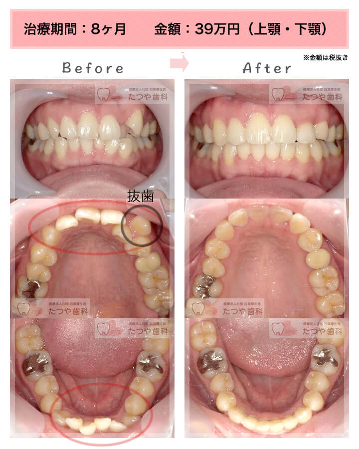 部分矯正の症例　八重歯