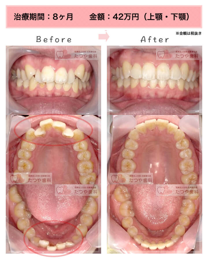 部分矯正の症例　八重歯