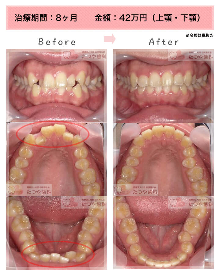 部分矯正の症例　八重歯