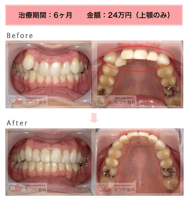 部分矯正の症例　八重歯