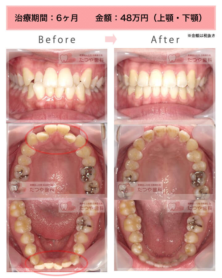 部分矯正の症例　八重歯