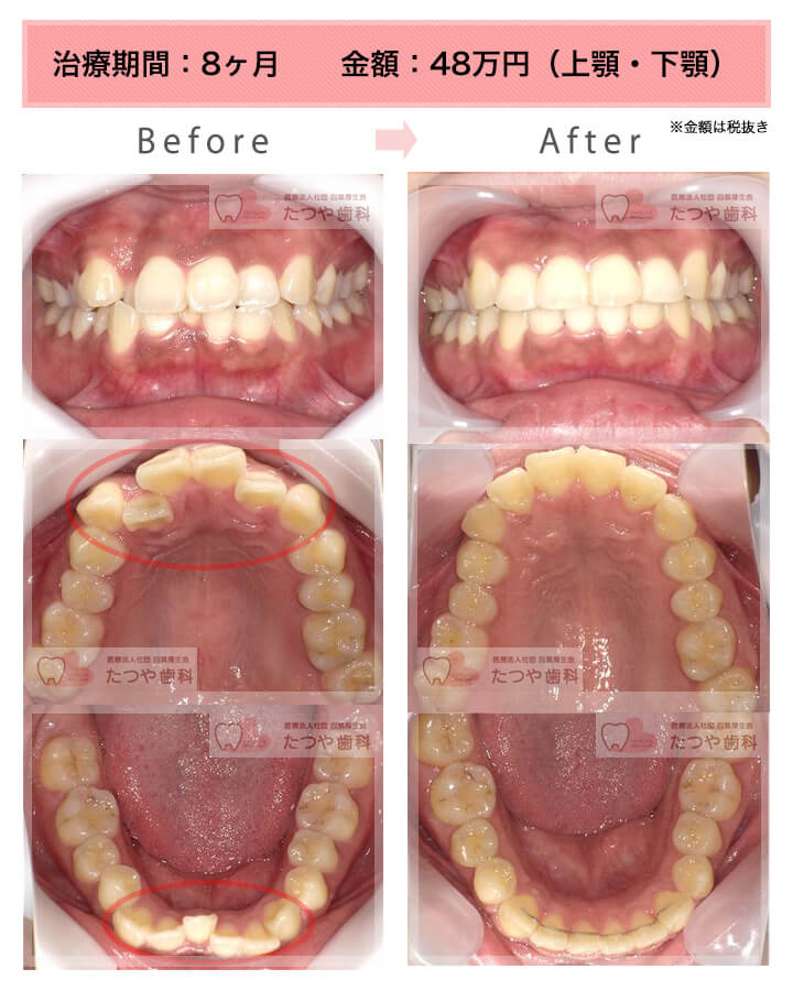 部分矯正の症例　八重歯