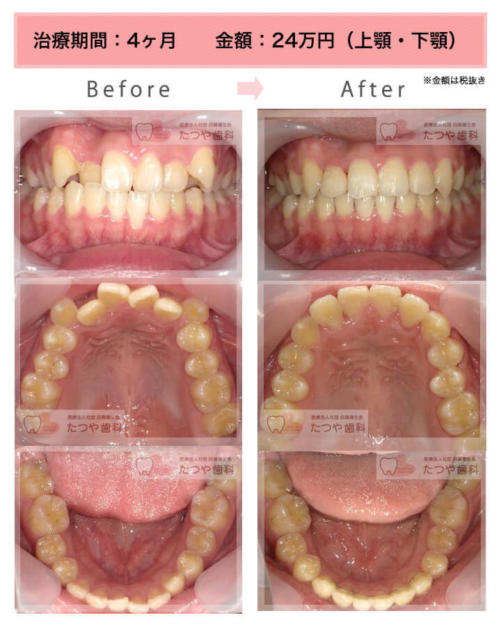部分矯正の症例　八重歯