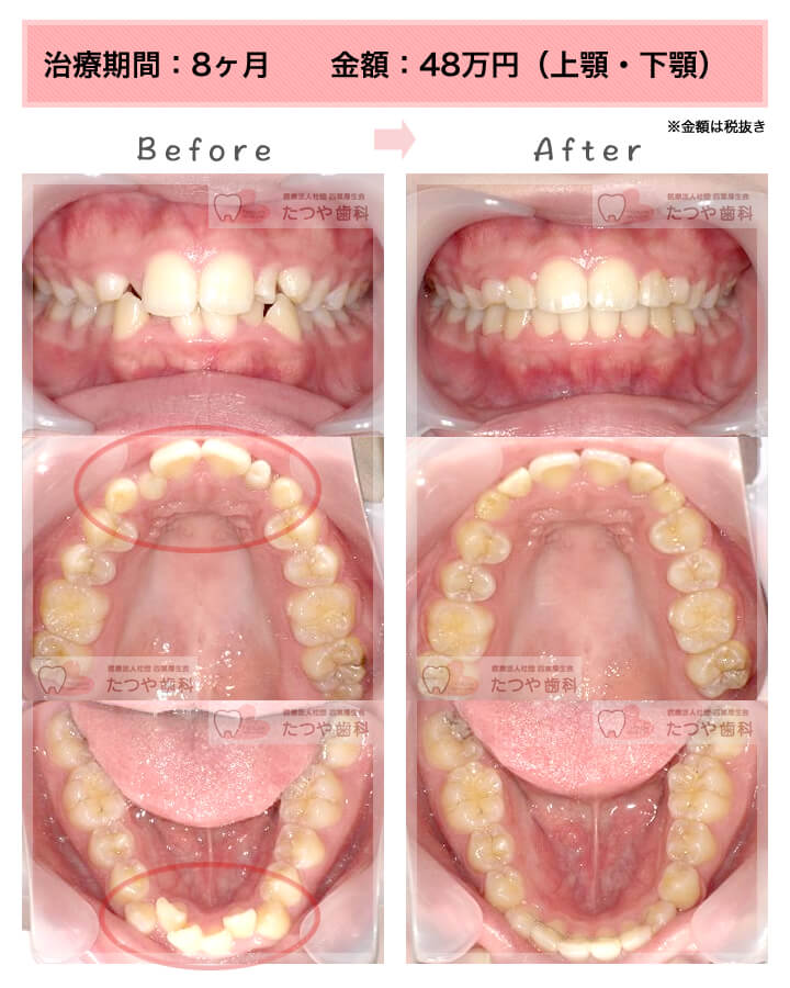 部分矯正の症例　八重歯