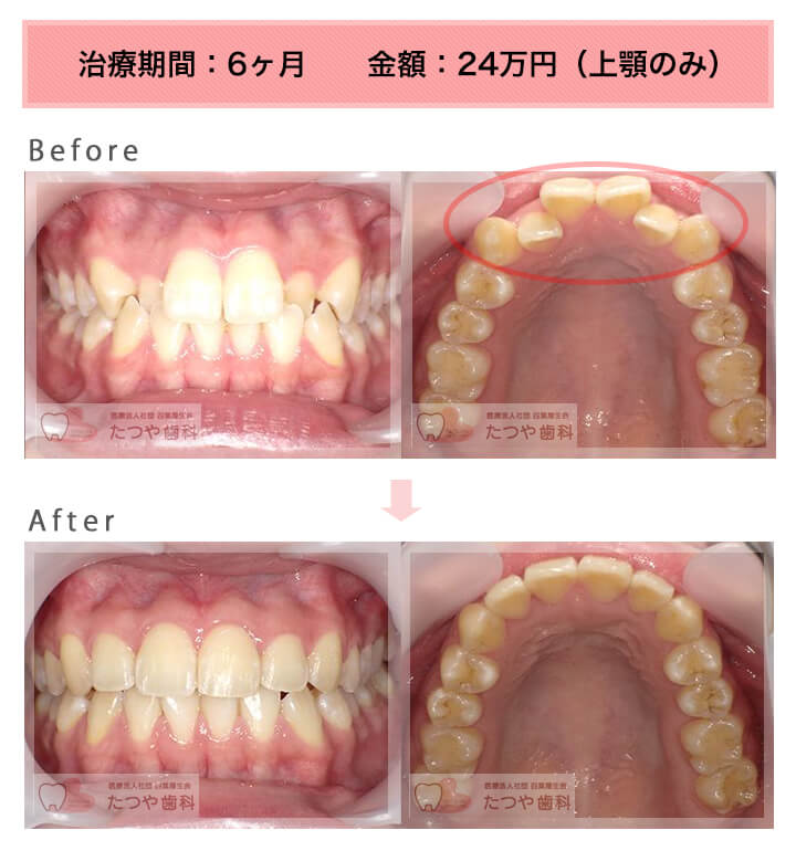 部分矯正の症例　八重歯