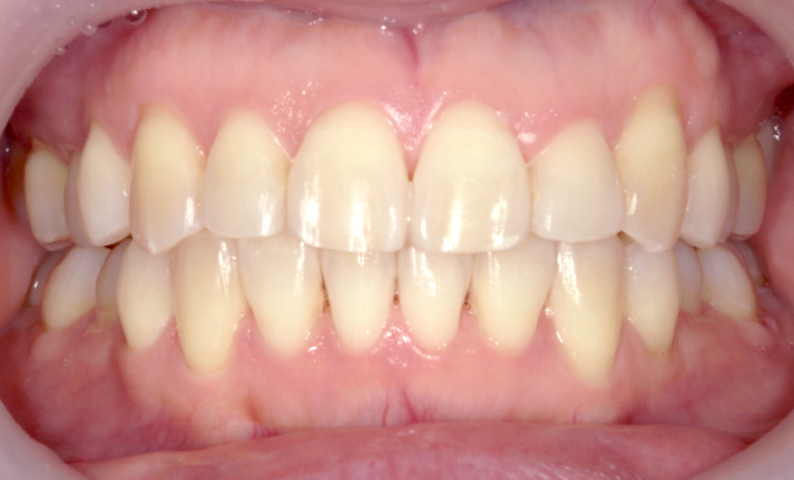 上下の部分矯正 症例写真