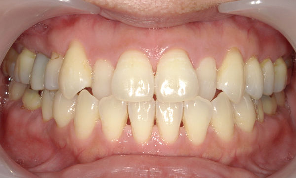 部分矯正 八重歯の症例写真
