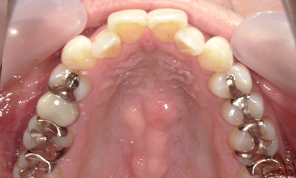 部分矯正 八重歯の症例写真