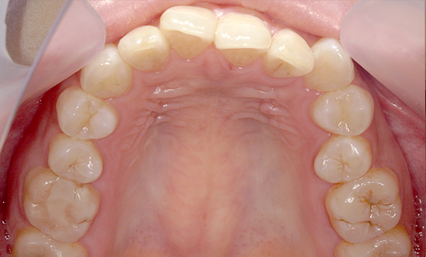 部分矯正 八重歯の症例写真