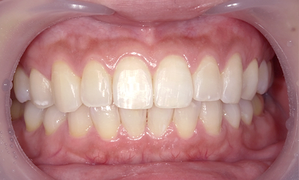 部分矯正 八重歯の症例写真