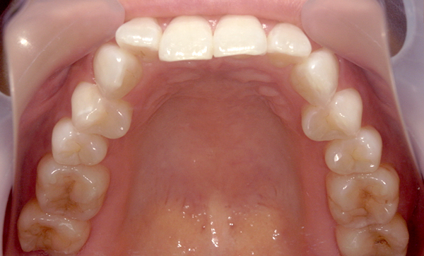 部分矯正 八重歯の症例写真