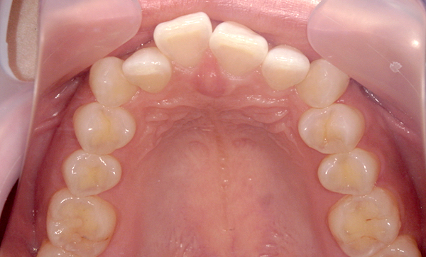 部分矯正 八重歯の症例写真