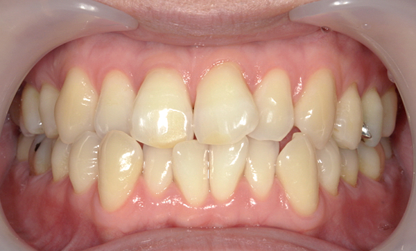部分矯正 八重歯の症例写真