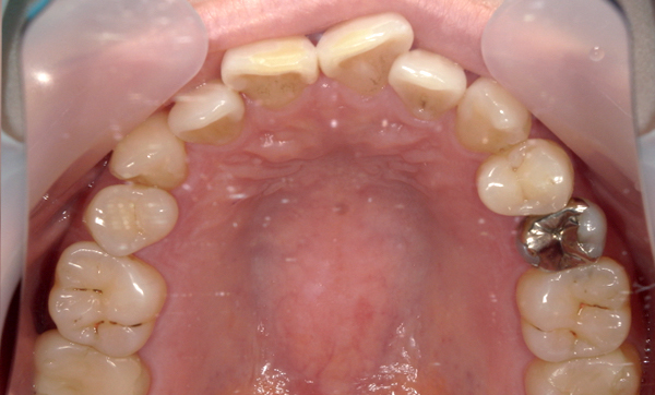部分矯正 八重歯の症例写真
