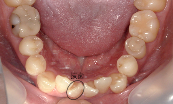 部分矯正 八重歯の症例写真