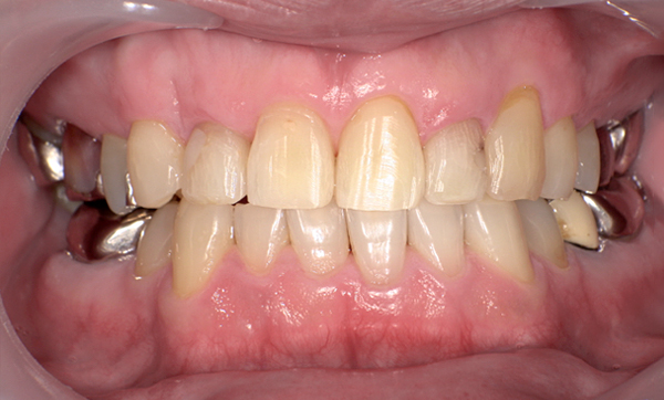 部分矯正 八重歯の症例写真