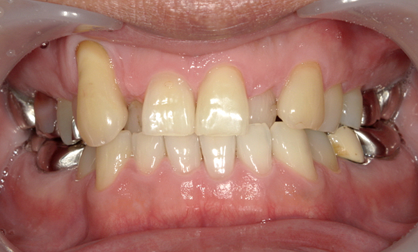 部分矯正 八重歯の症例写真