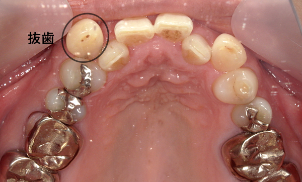 部分矯正 八重歯の症例写真