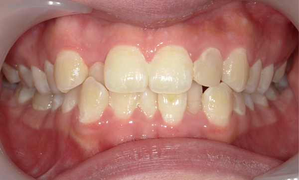 部分矯正 八重歯の症例写真