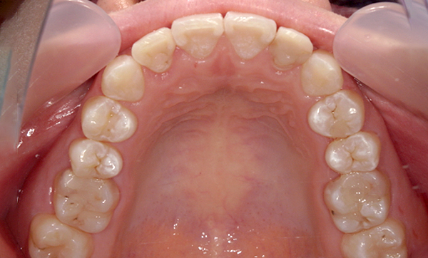 部分矯正 八重歯の症例写真